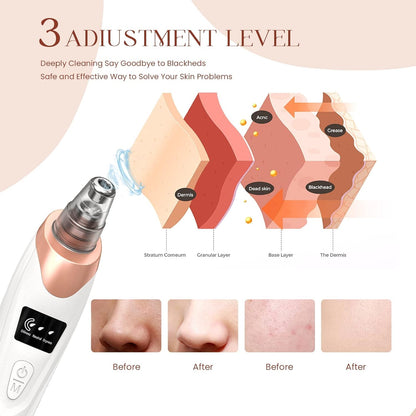 Electric blackhead remover