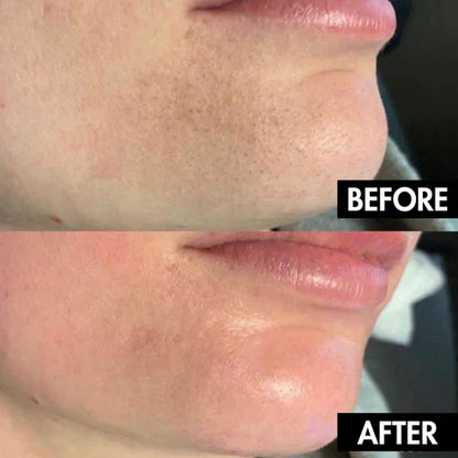 Electric blackhead remover